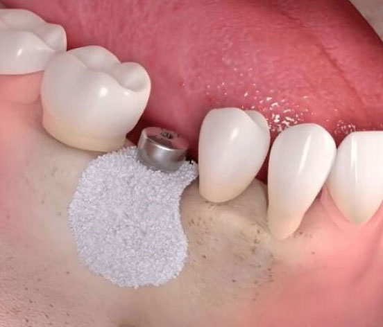 bonecraft dental