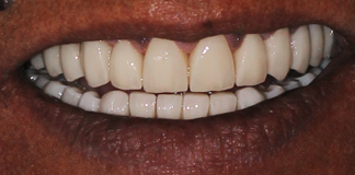 Full Mouth Rehabilitation Using Zirconia Crowns And Implants By Dr. Aastha Chandra At Opal Dental Care Studio, Mumbai, India